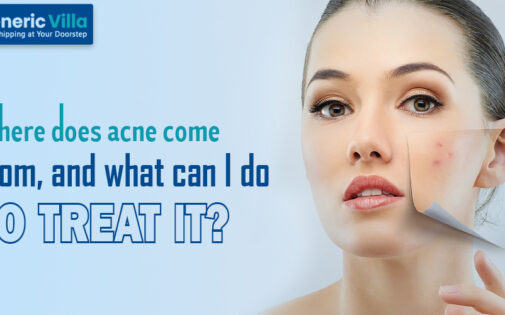Where does acne come from, and what can I do to treat it?