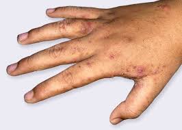 rosacea treat