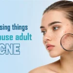 Surprising Things Can Cause Adult Acne